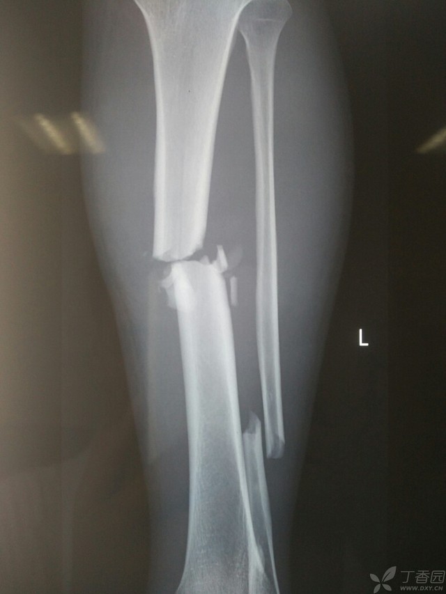 科技重塑脛腓骨骨折康復之旅，引領未來體驗新篇章