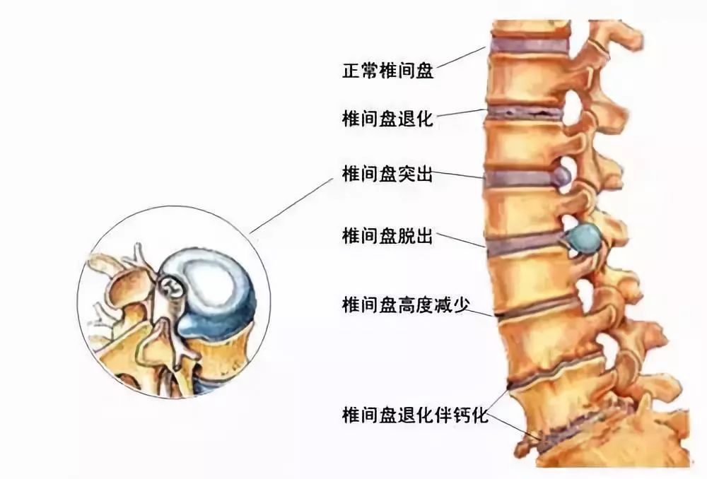 最新腰椎盤與歡樂大家庭的互動(dòng)日常