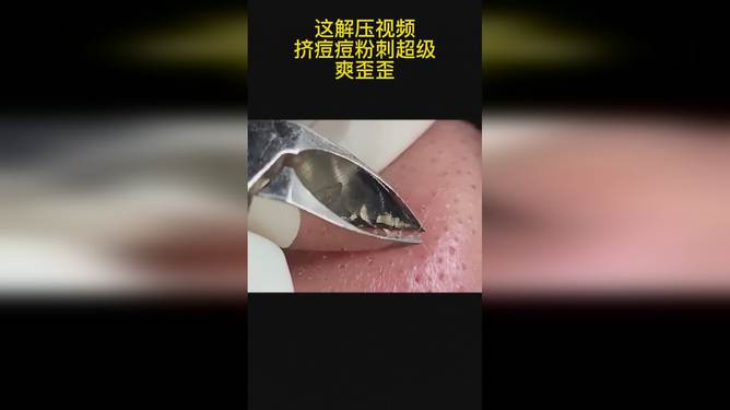 最新擠膿包視頻，見證變化的力量，自信與成就感的誕生之地