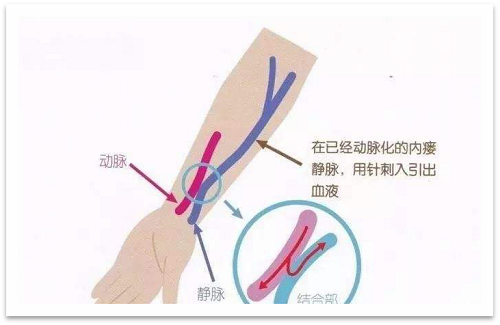 靜脈瘺最新資訊，掌握最前沿的健康信息
